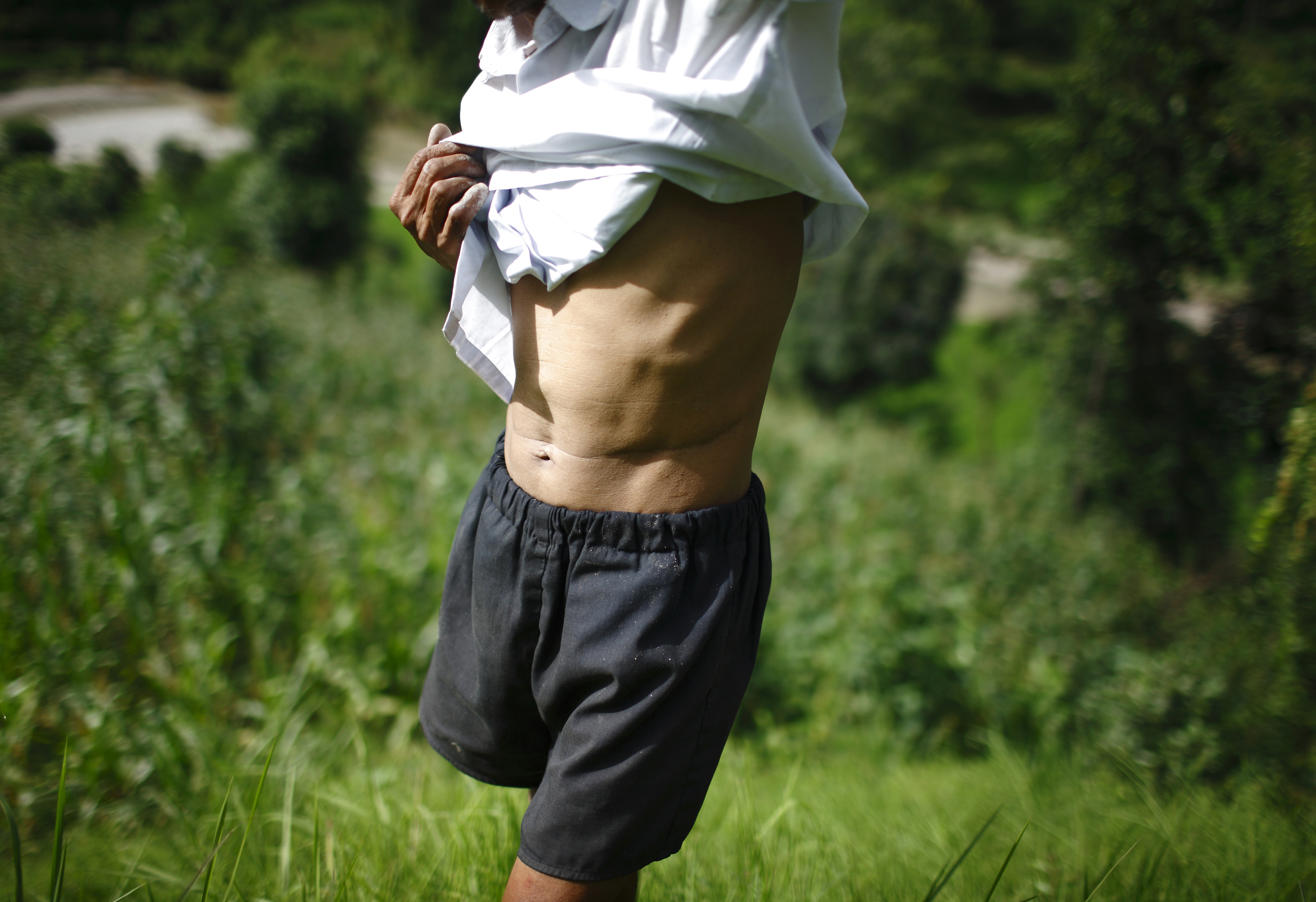 Krishna Bahadur Bajagai, 60, who sold his kidney due to poverty, lifts his shirt to show the incision scar from the operation, in Kavre